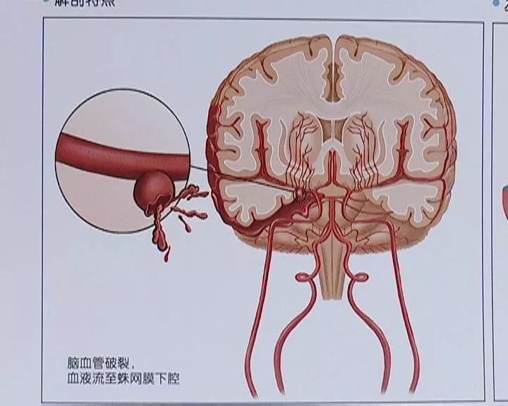 脑液血突发过世，脑液血病人是什么症状 